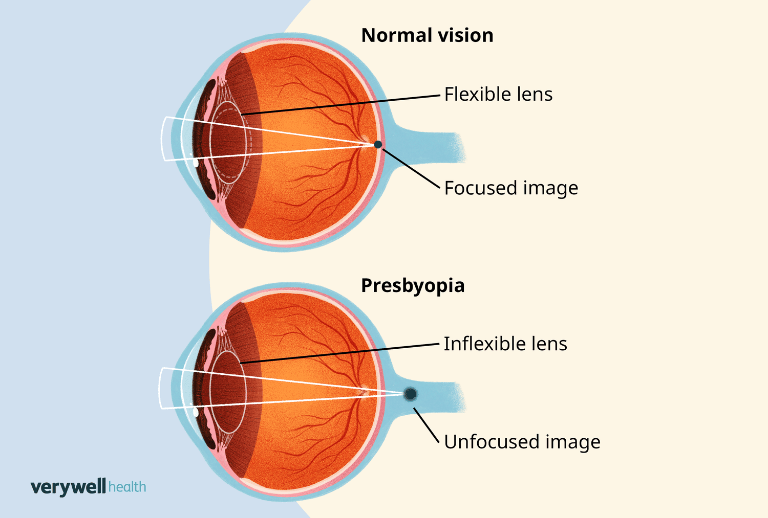 Mastering Clear Vision: Tackling Near-Sightedness After 40